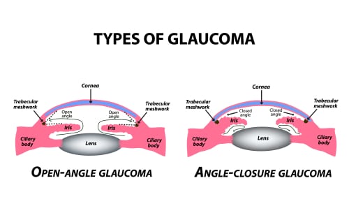 Types,Of,Glaucoma.,Open-angle,And,Angle-closure,Glaucoma.,The,Anatomical,Structure